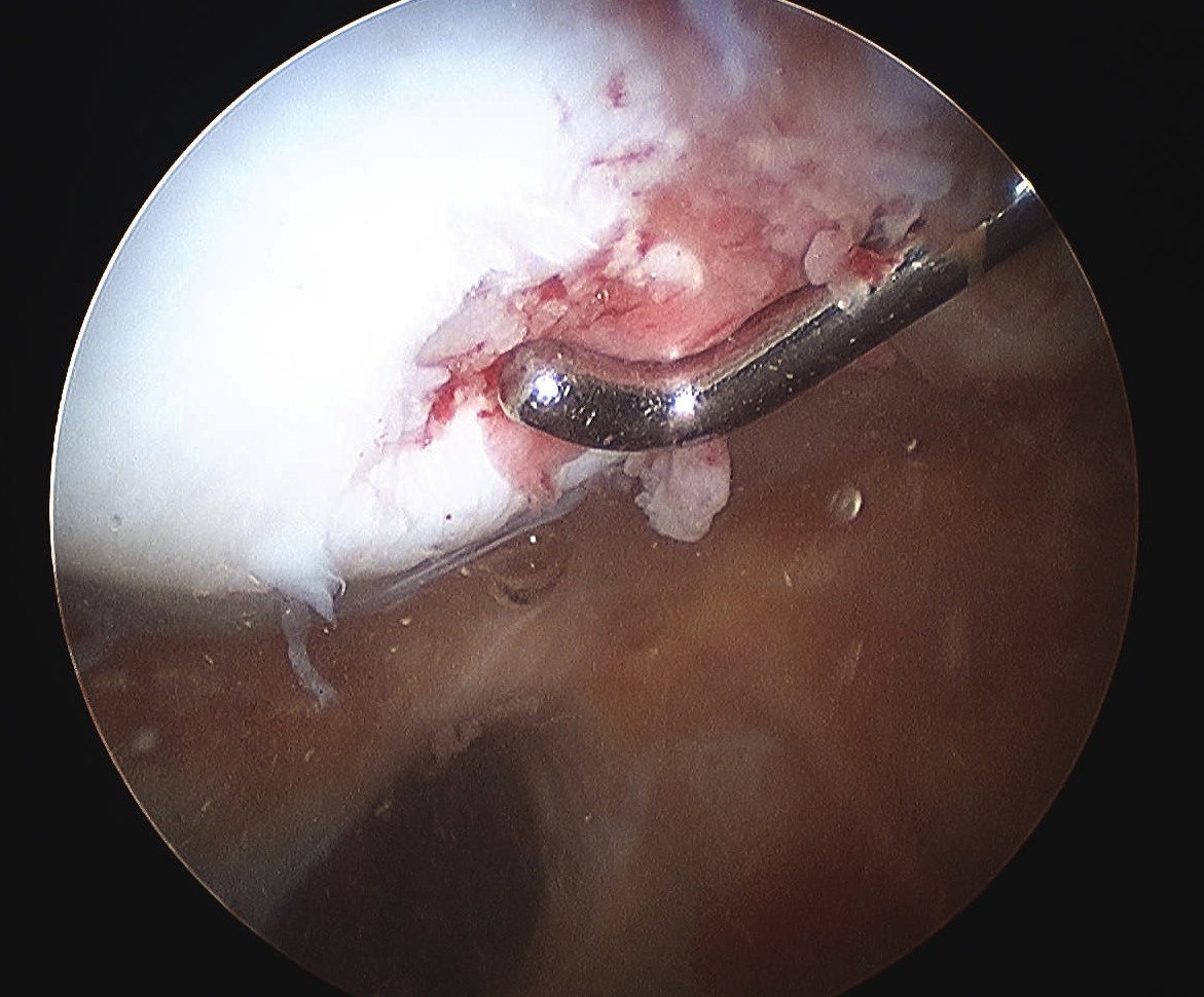 Patella Dislocation Removal Medial Facet Cartilage